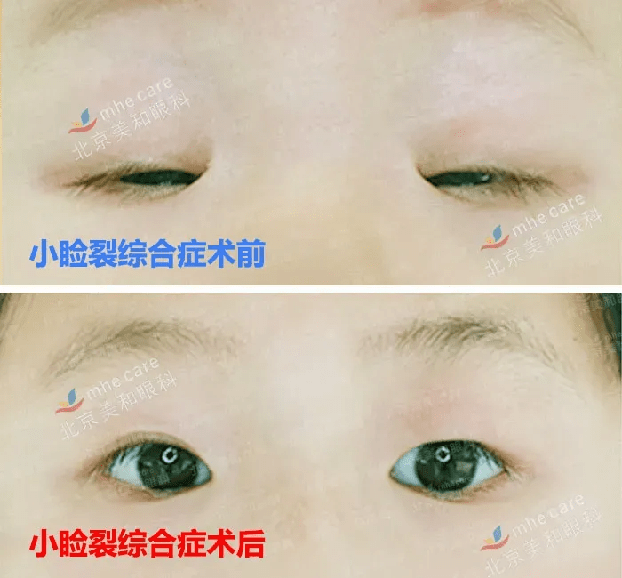 手术|五年八部曲，上睑下垂分阶段治疗的故事