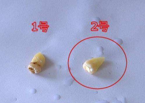 牙齿长到牙龈上怎么办