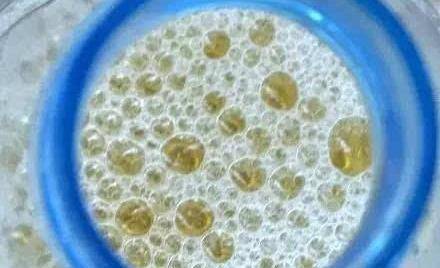 症状|尿液出现3种“泡沫”，早点去医院做检查，当心是疾病的信号