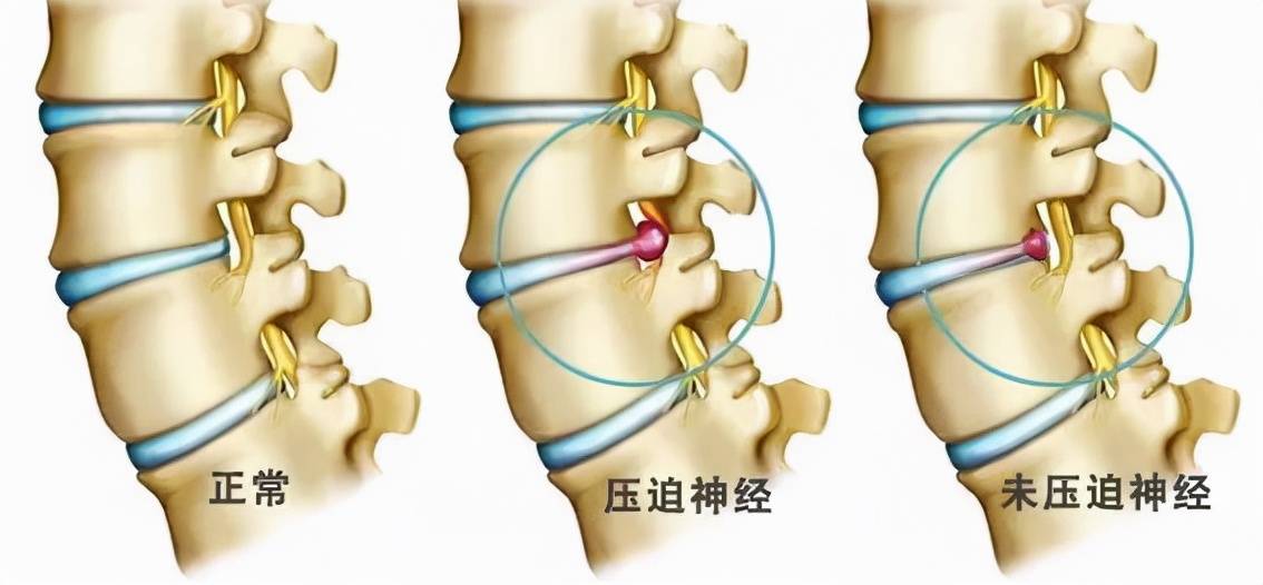 后期症状:整体神经丛被压迫,彻底无法逆转时,会出现马尾综合征,严重时