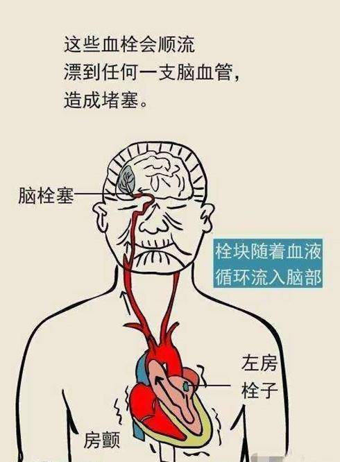 心脏|房颤不仅仅是心慌这么简单！房颤不治疗会导致脑梗死！