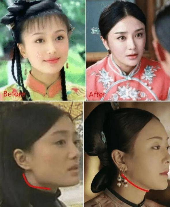 变化那些削骨“一刀切”的明星还好吗？有的已垮掉，小方脸成最后赢家