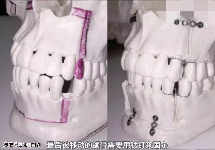 宋轶凸嘴无法修复的四种迹象,千万别中招