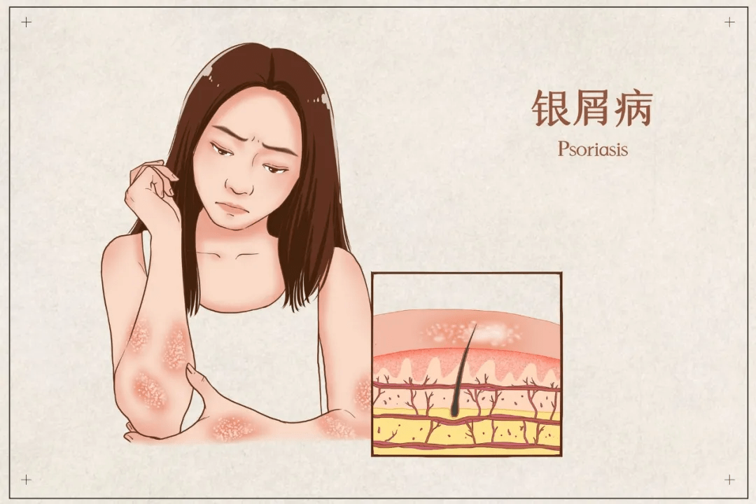 银屑病如何缓解瘙痒症状?