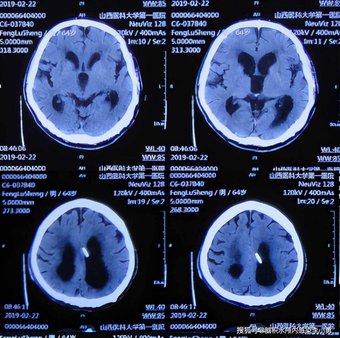 并发脑萎缩的老年正常压力脑积水步态不稳走路前冲不能控制