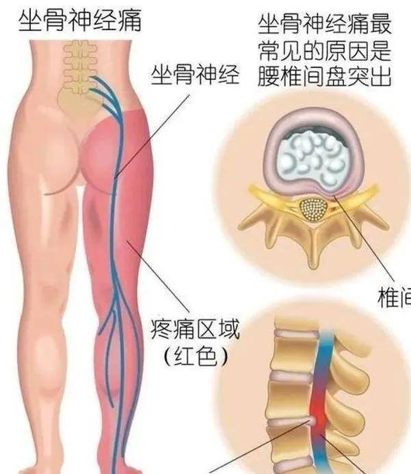 什么是坐骨神经病 3633e8fa79304fd78b56959105e7ae38.jpeg