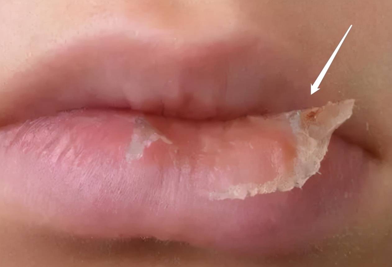 孩子嘴唇裂口又出血,还忍不住撕嘴皮,大夫的处理方式有些意外_团子