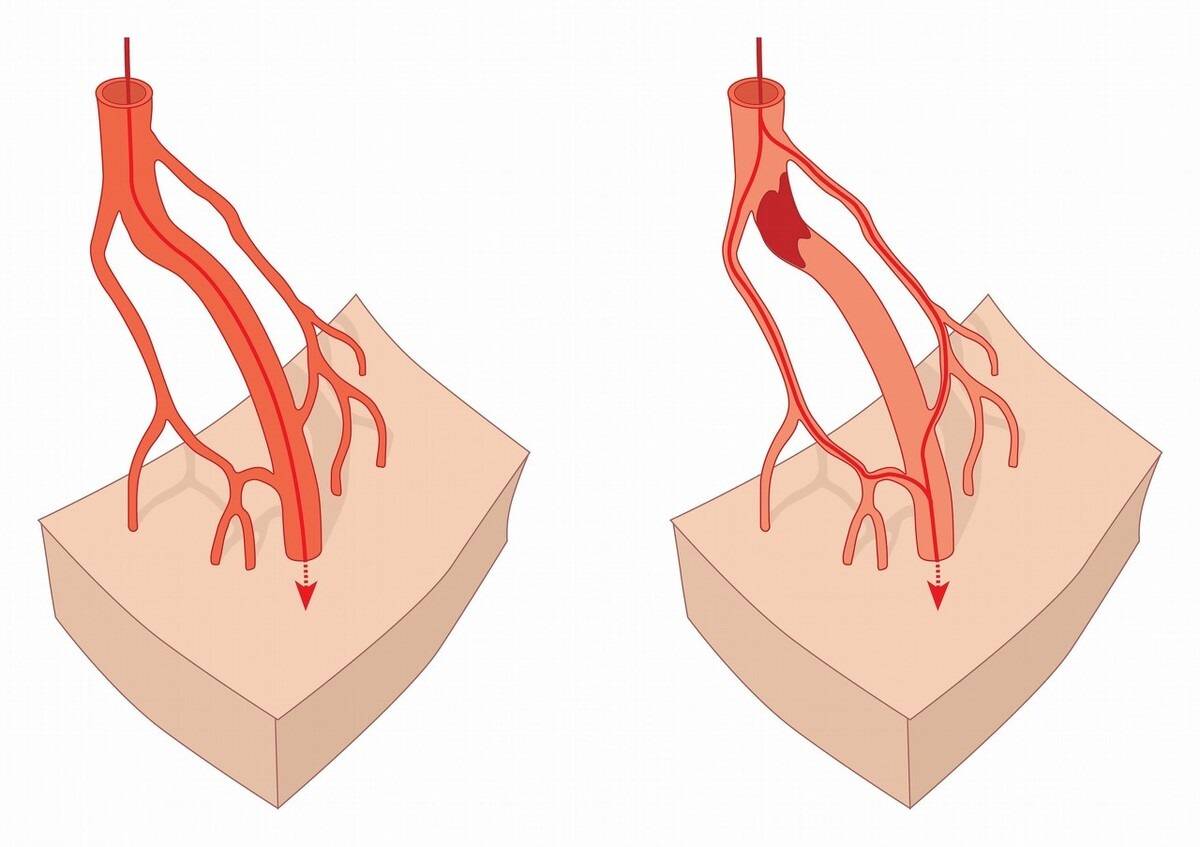 无症状的心肌缺血,危险性更高,中老年人要注意_患者_冠脉_治疗