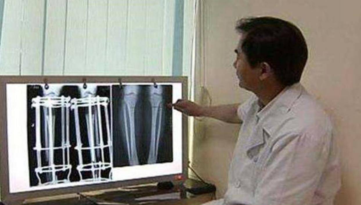 后遗症20岁小伙花了家里16万断骨，只为增高7.2厘米，如今与后遗症为伴