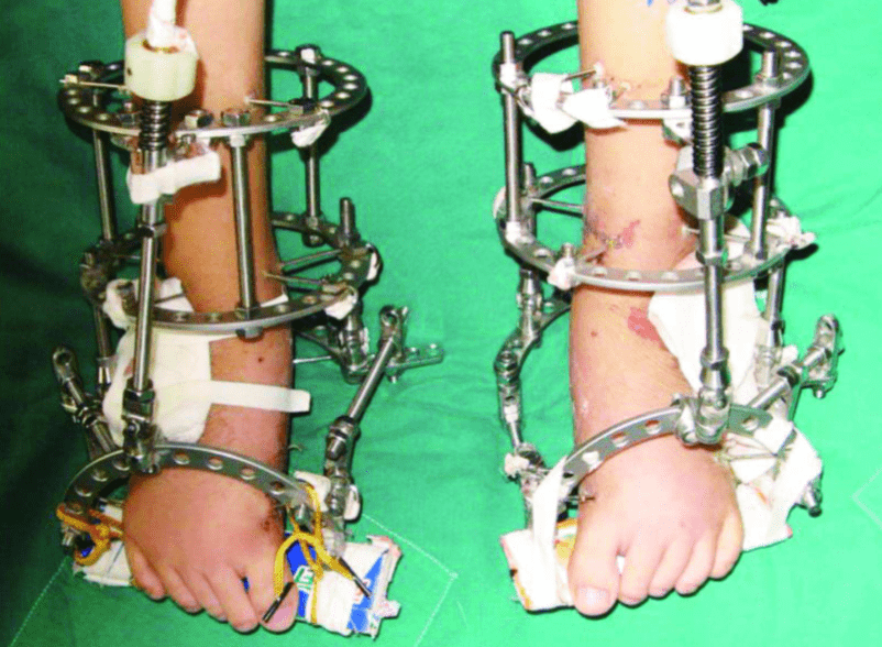 故事曾为长高72厘米花16万断骨增高现后遗症如何