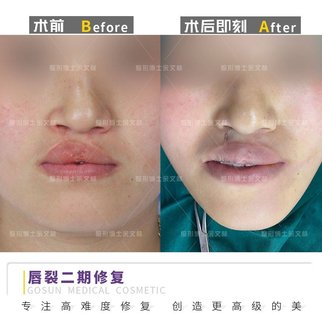 唇裂二期红唇修复可以达到什么效果?