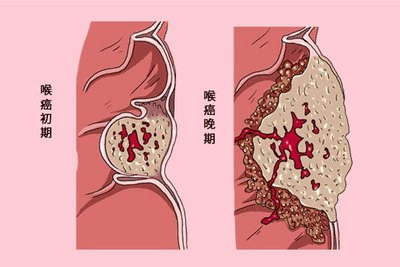 喉癌检查报告单图片图片