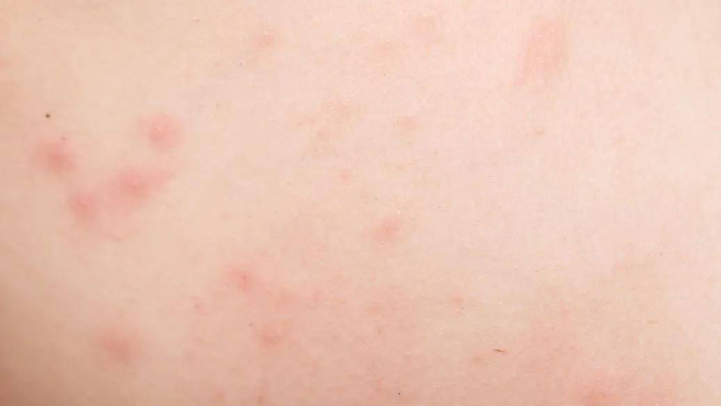 患儿|肺炎支原体感染频发，这些问题一定要知道！