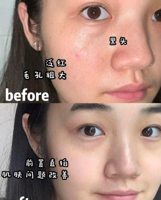 黑头国内有一“低调”纯露，因便宜被嫌弃，用后黑头闭口渐渐消失