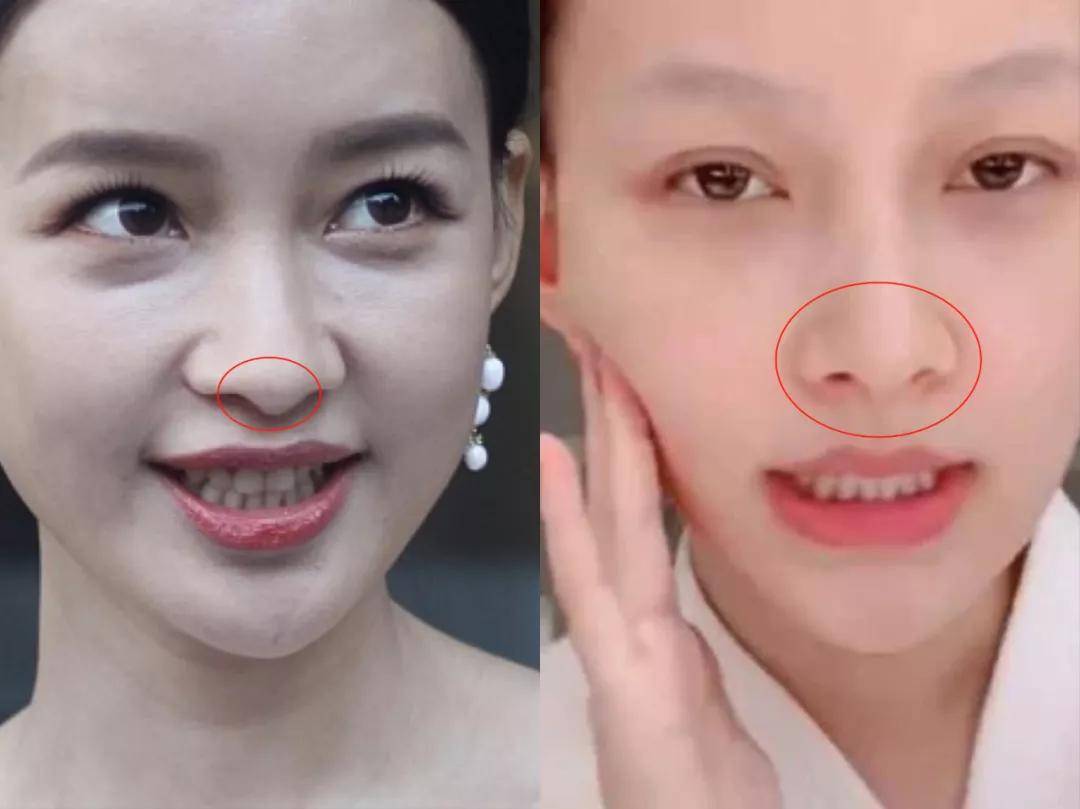 鼻头抬高的同时也解决了鼻小柱下垂的痛点,视觉上中庭缩短,三庭比例