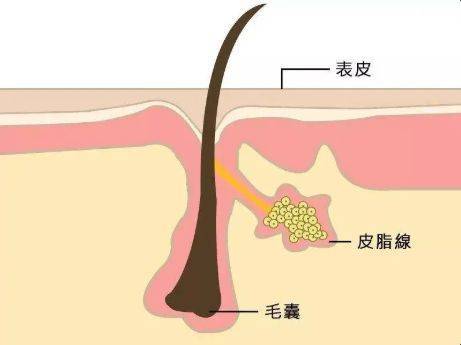 stI.st揭秘“为何痘痘偏爱油性皮肤？”