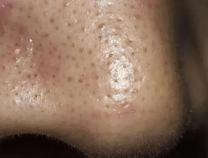 人群嘉玲护肤老师：毛孔粗大怎么破