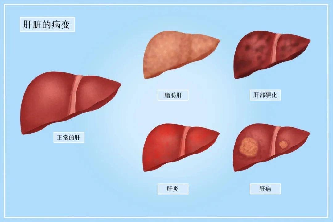 活动|哪些人容易感染乙肝？6类高危人群要注意