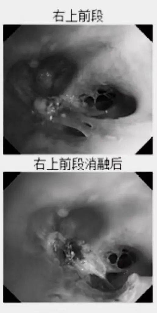 支气管|合肥京东方医院：支气管镜下介入治疗改变以往取肿瘤需“开膛破肚”的境况