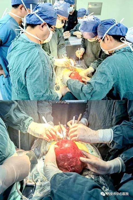 疫情|疫情之中见仁心——西安市中心医院MDT团队成功切除15公斤腹膜后巨大肿瘤