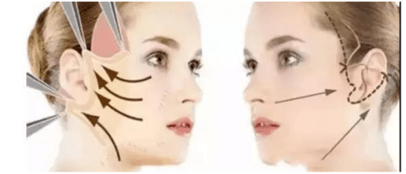 什么黄金微雕和线雕有什么区别？法令纹做线雕效果怎么样？