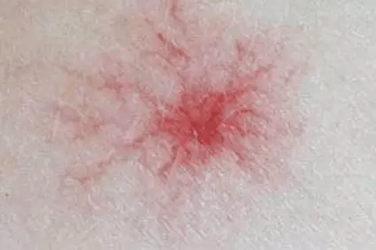 身上痒是肝脏有毛病吗 37281da1e15f4682baa238b2382a82a5.png