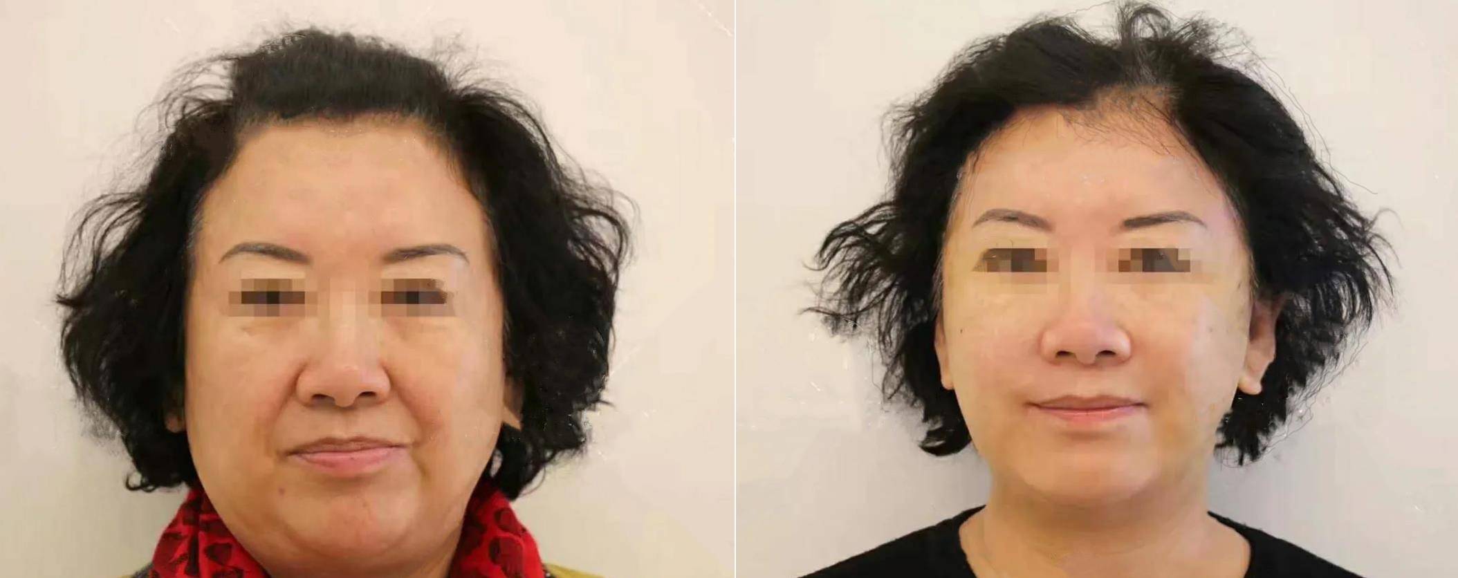 大姐60岁大姐面部提升真实经历：术后10天换脸实拍，为了美她也是拼了