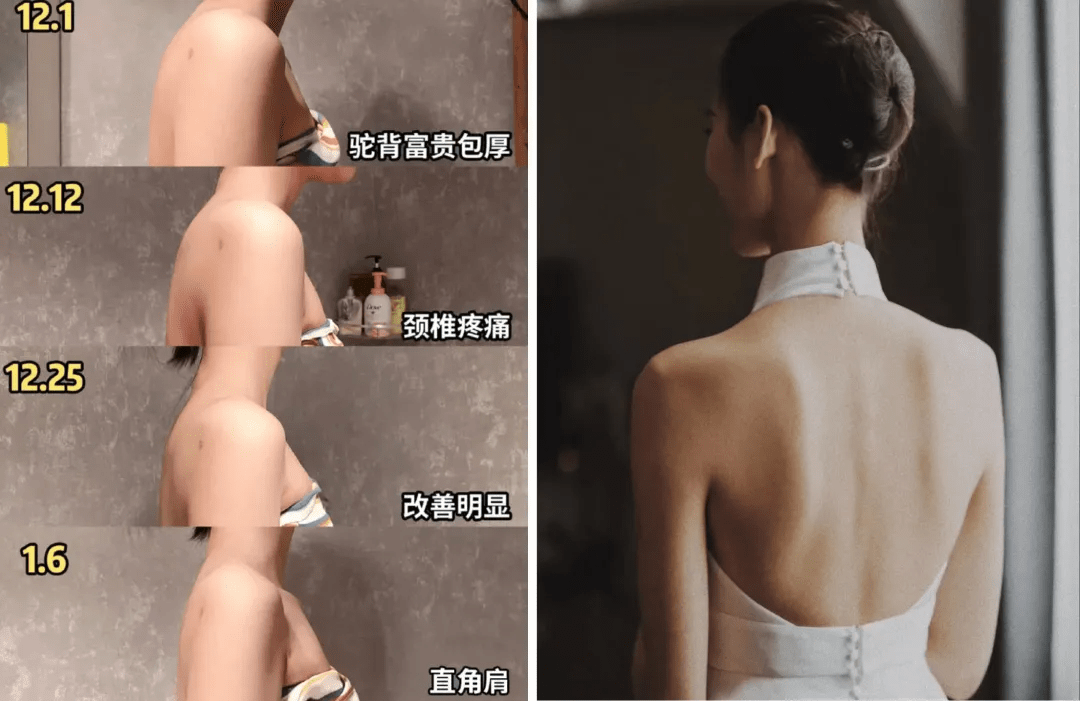 张雨绮杨颖近照曝光，瘦到“皮包骨”粉丝担忧！背部做了手术？