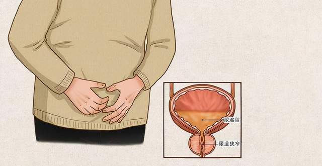 前列腺排不出尿怎么办