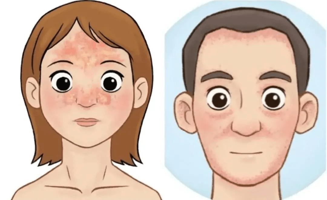 什么是脂溢性皮炎你一定要知道这些