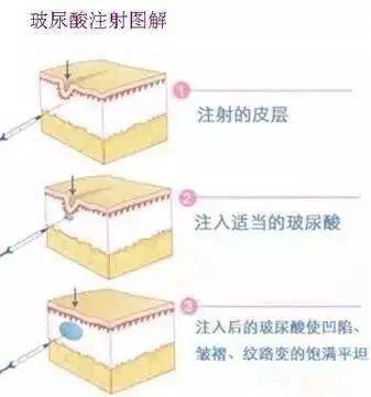 分子医美科普 | 一次玻尿酸美容后，需要持续打吗？