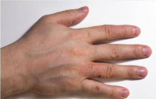 神经系统|体内有病，手指先知？手指出现4种迹象，占一个，也要警惕