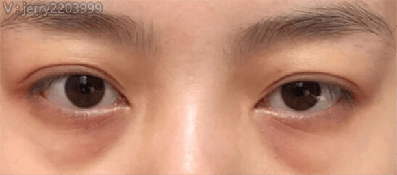 眼袋艾玛珂儿丨如何眼细纹等问题！
