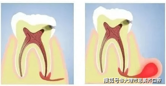 牙髓炎最明顯的表現就是劇烈的自發性和陣發性牙痛,夜間發作更為頻繁