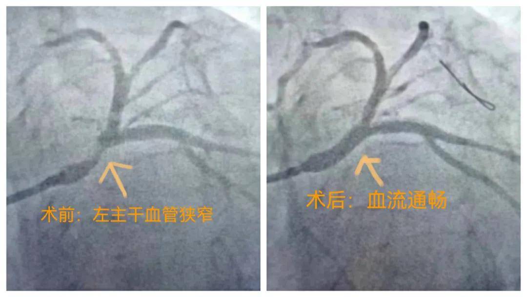 高发季|心梗高发季：5G加持，看心内科如何“速”效救“心”