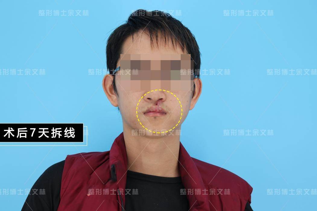 【案例分析】26歲男子紅唇輕微缺損,唇裂二期修復手術過程分析_鼻孔