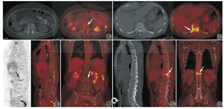 左:单纯良性椎体压缩性骨折患者(男,62岁)18f-fdg pet/ct显像图.