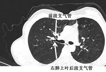 支氣管告密這個肺部ct有問題