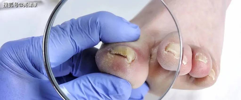 得了灰指甲怎么治这2个治疗方法效果好