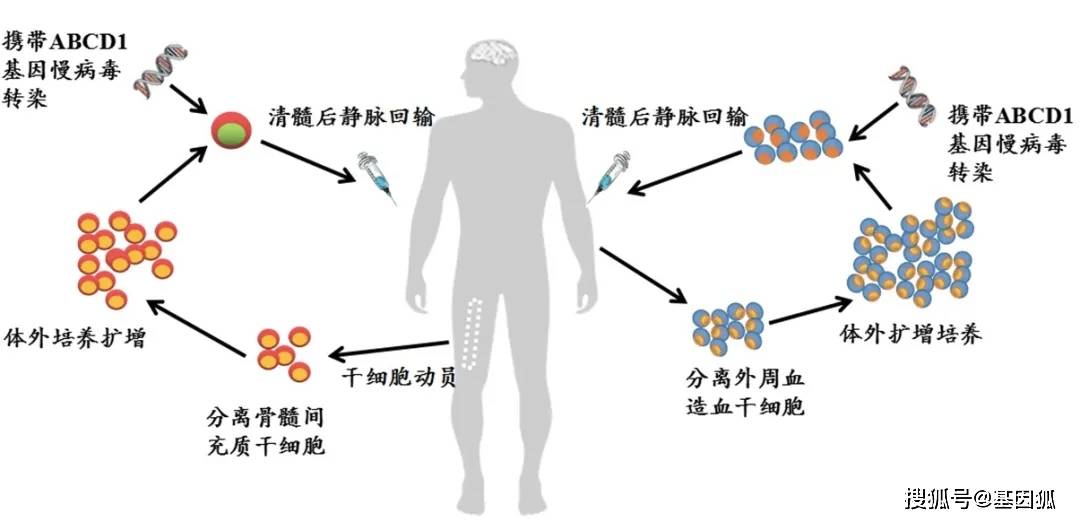 双重干细胞基因疗法治疗多项遗传疾病,对七种基因疾病进行深入研究