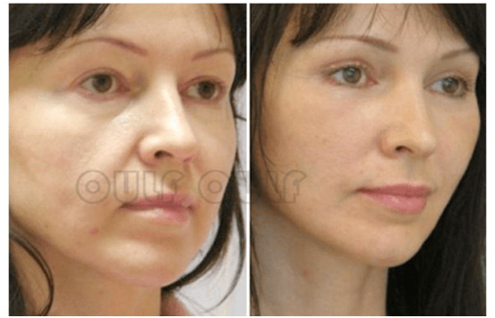 脸部浅谈脸部下垂做线雕好还是拉皮好、脸部做线雕有副作用吗?