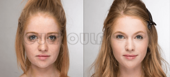 玛吉实话实说:经常做热玛吉会有后遗症吗、热玛吉保持时间是多久?