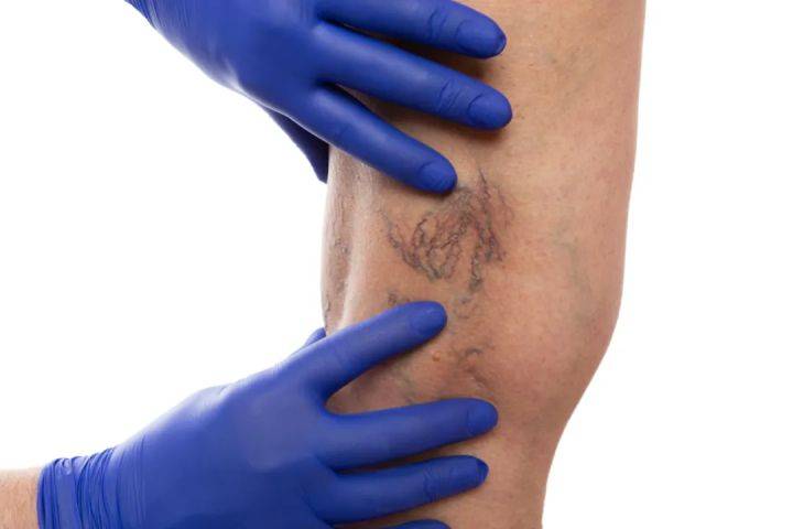 毛细血管扩张就是静脉曲张吗?_下肢_皮肤_舒尔