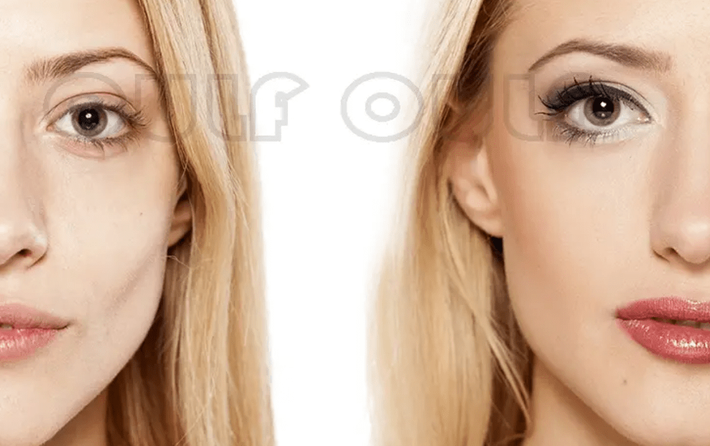 什么科普篇:ppdo线雕是什么线?ppdo线雕维持时间?