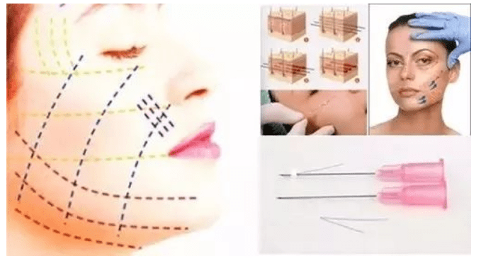 什么科普篇：ppdo线雕是什么线？ppdo线雕维持时间？