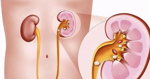 尿酸|五个痛风就有一个尿酸性肾结石，肾石病是高尿酸血症引起的吗？