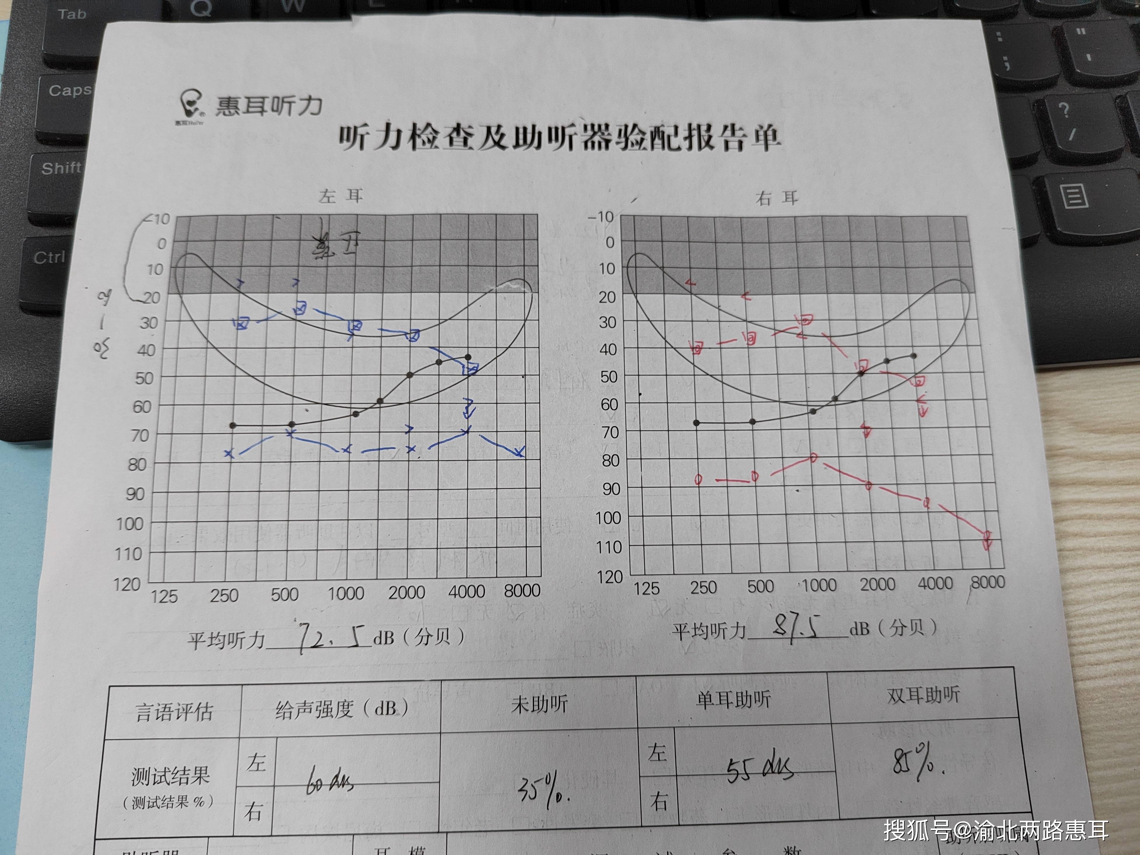 有耳鳴,無眩暈,有高血壓,無高血脂,無糖尿病3.無耳聾家族及遺傳病史2.