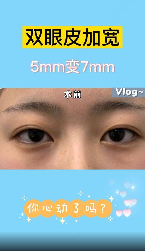 双眼皮修复,5mm变7mm,你心动了吗?