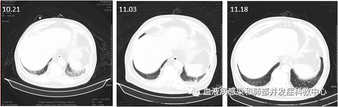 同年10月,患者在我院接受挽救性系統治後兩天,出現