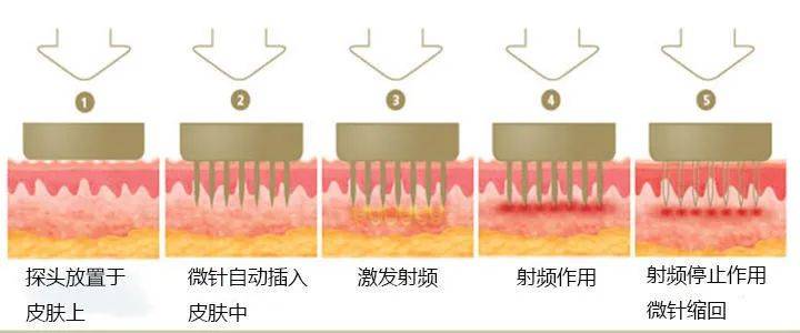 人群2022年求美者“宠儿”，黄金微针VS点阵激光丨咨询师必备